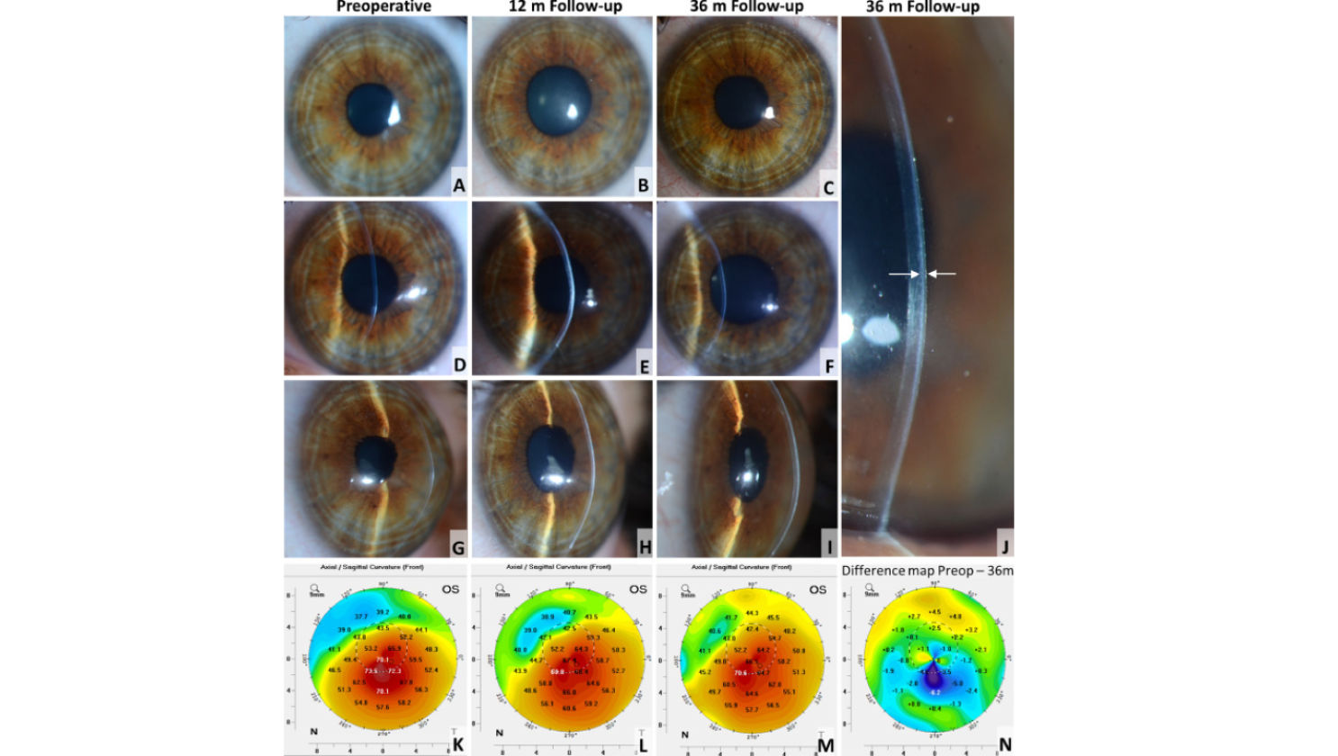 Overzichtsafbeelding (kleur) transplantatie bij keratoconus